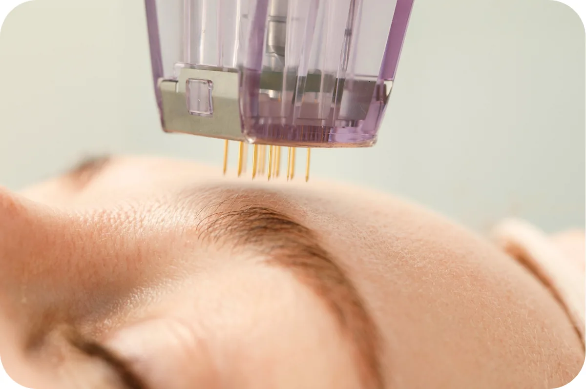 Tratamiento de Dermapen en Divay Estética, San Juan de Lurigancho