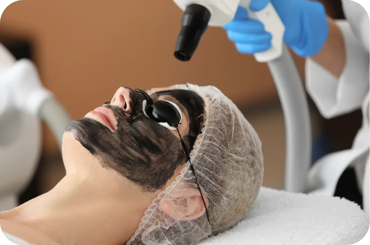 Tratamiento Hollywood Peel en Divay Estética, Los Olivos
